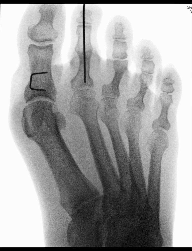 hammer-toe-2