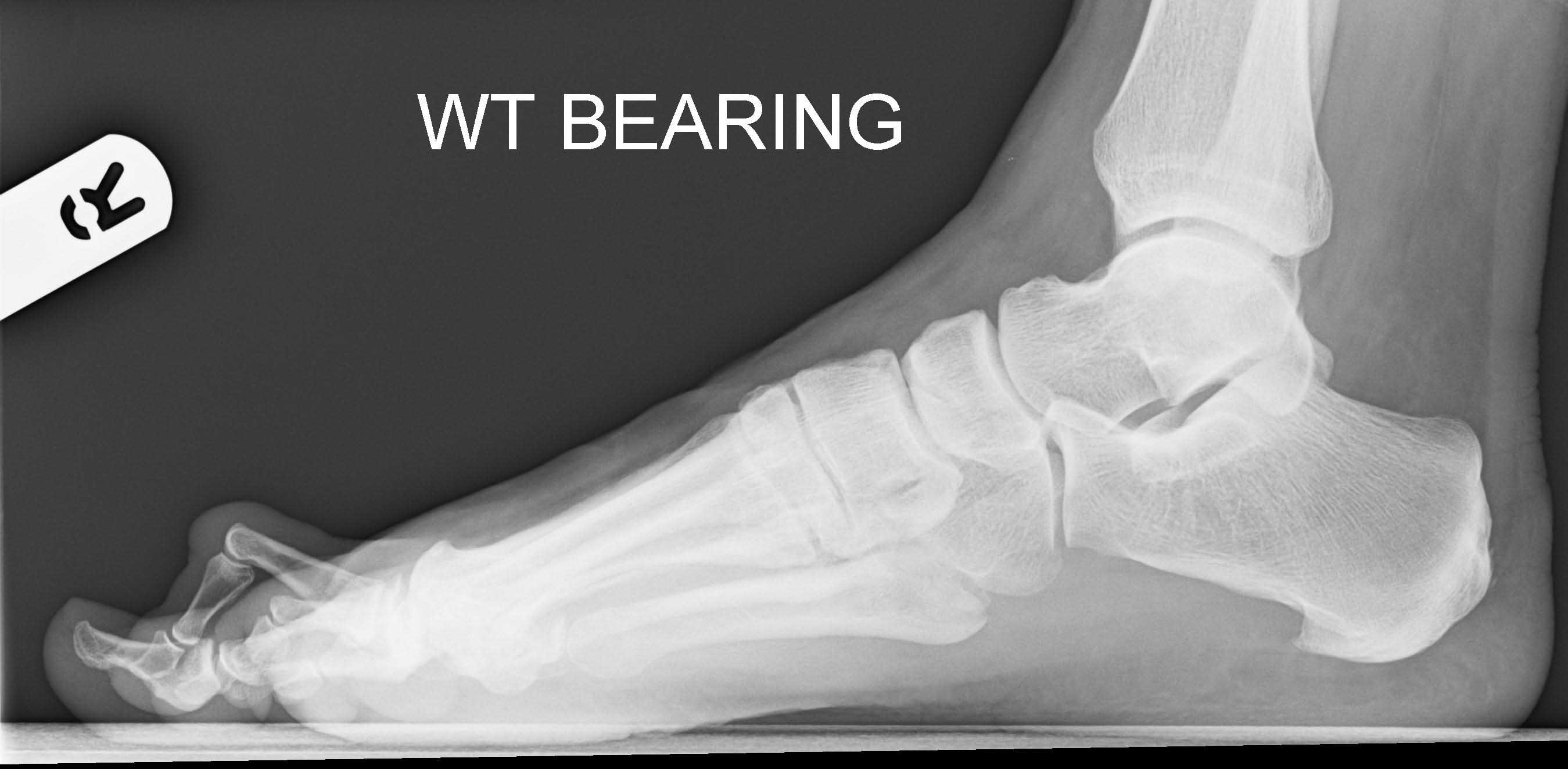 hammer-toe