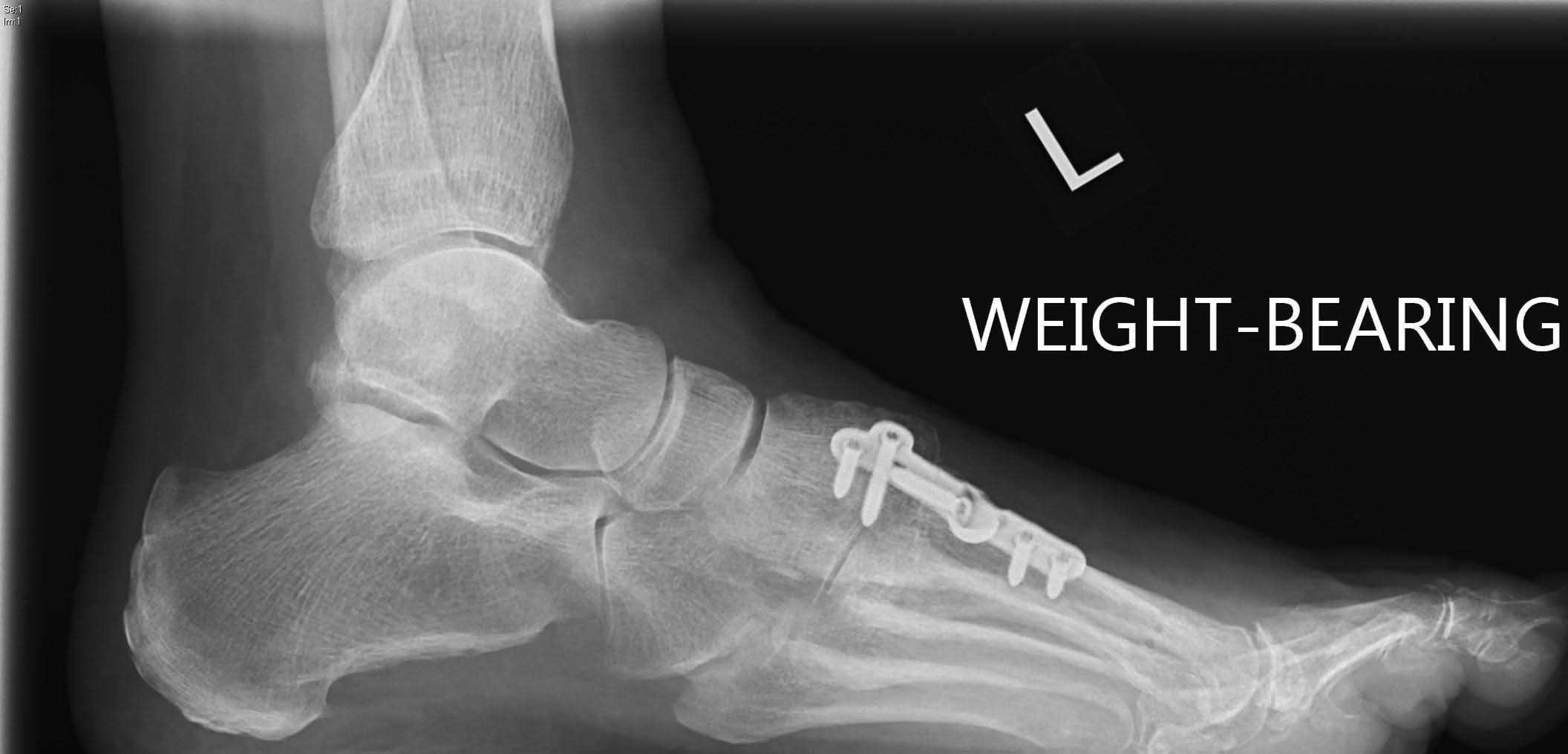 lapidus-ap-post-op-2