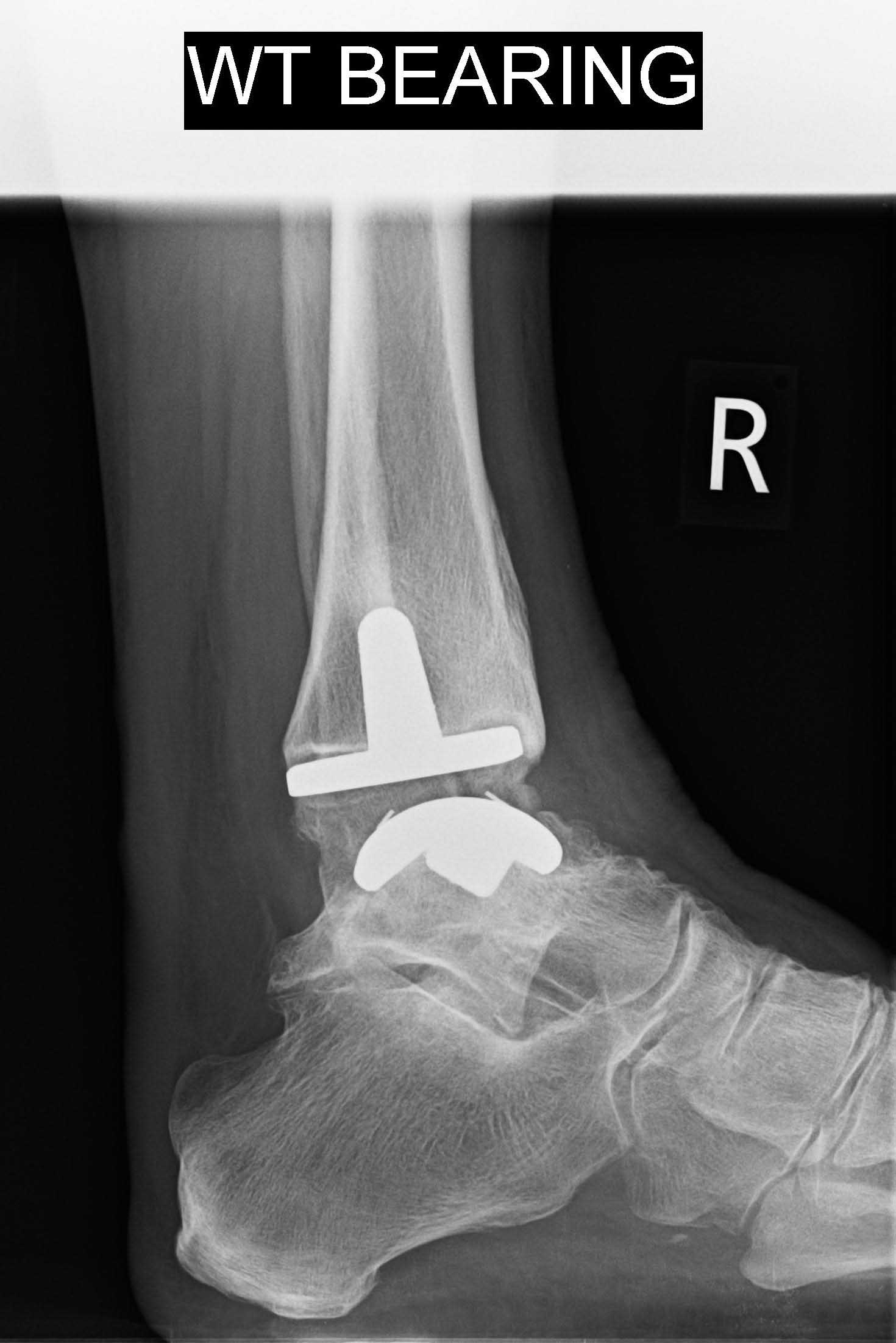 mobility-post-op-lat