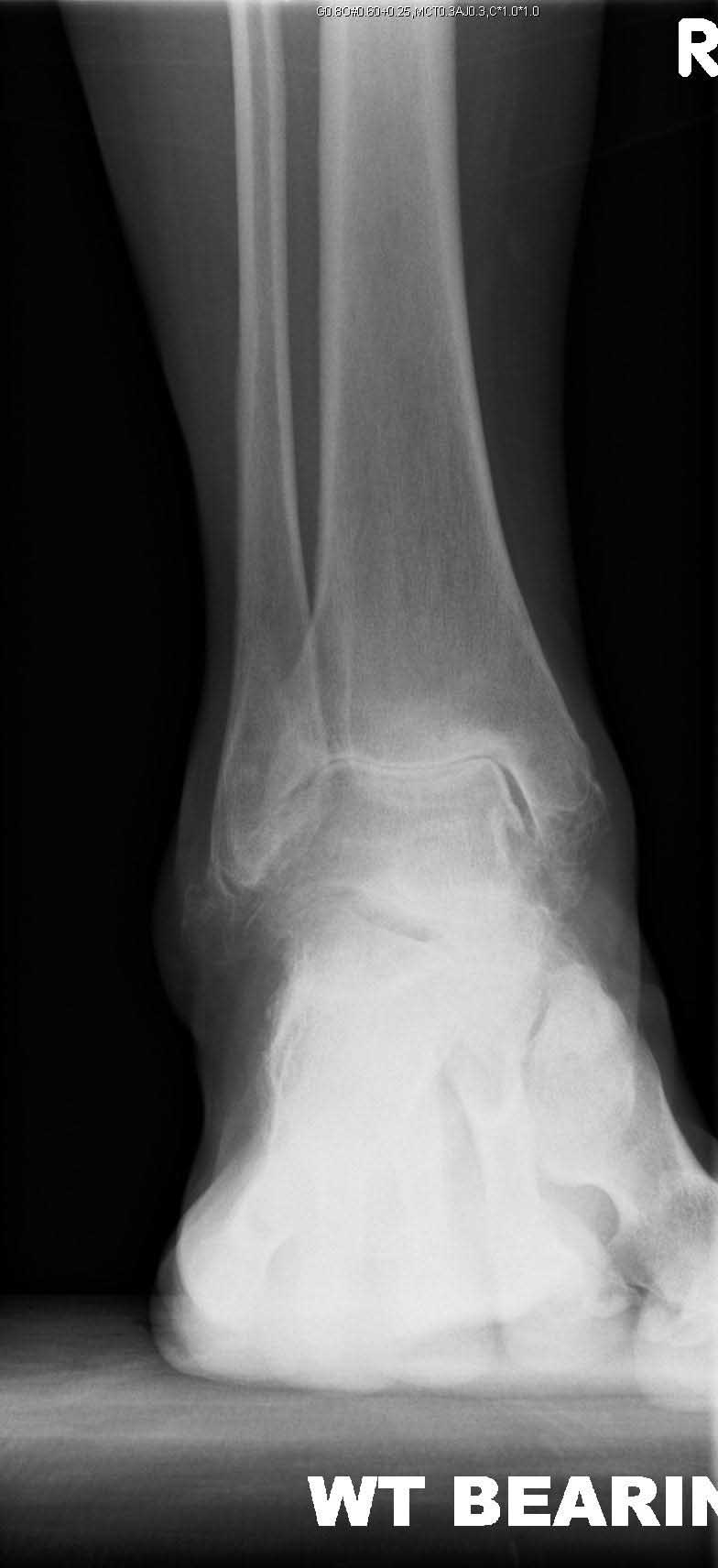 mobility-pre-op-ap