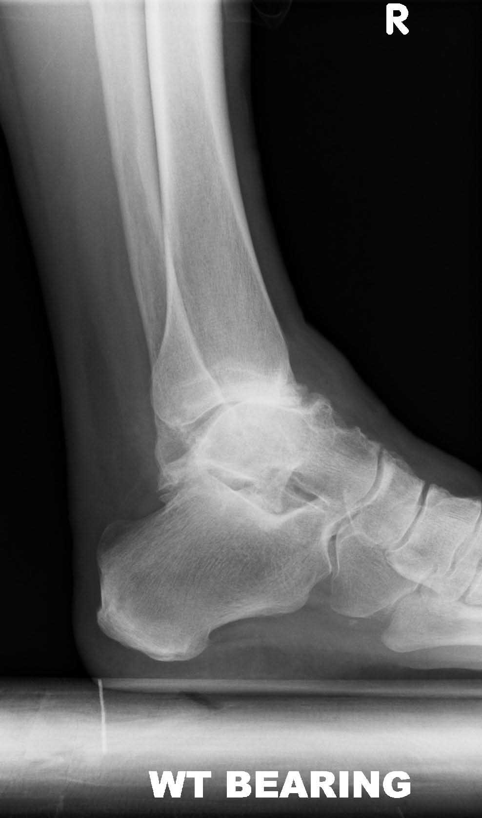 mobility-pre-op-lat