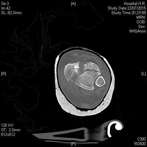pilon-ct-axial