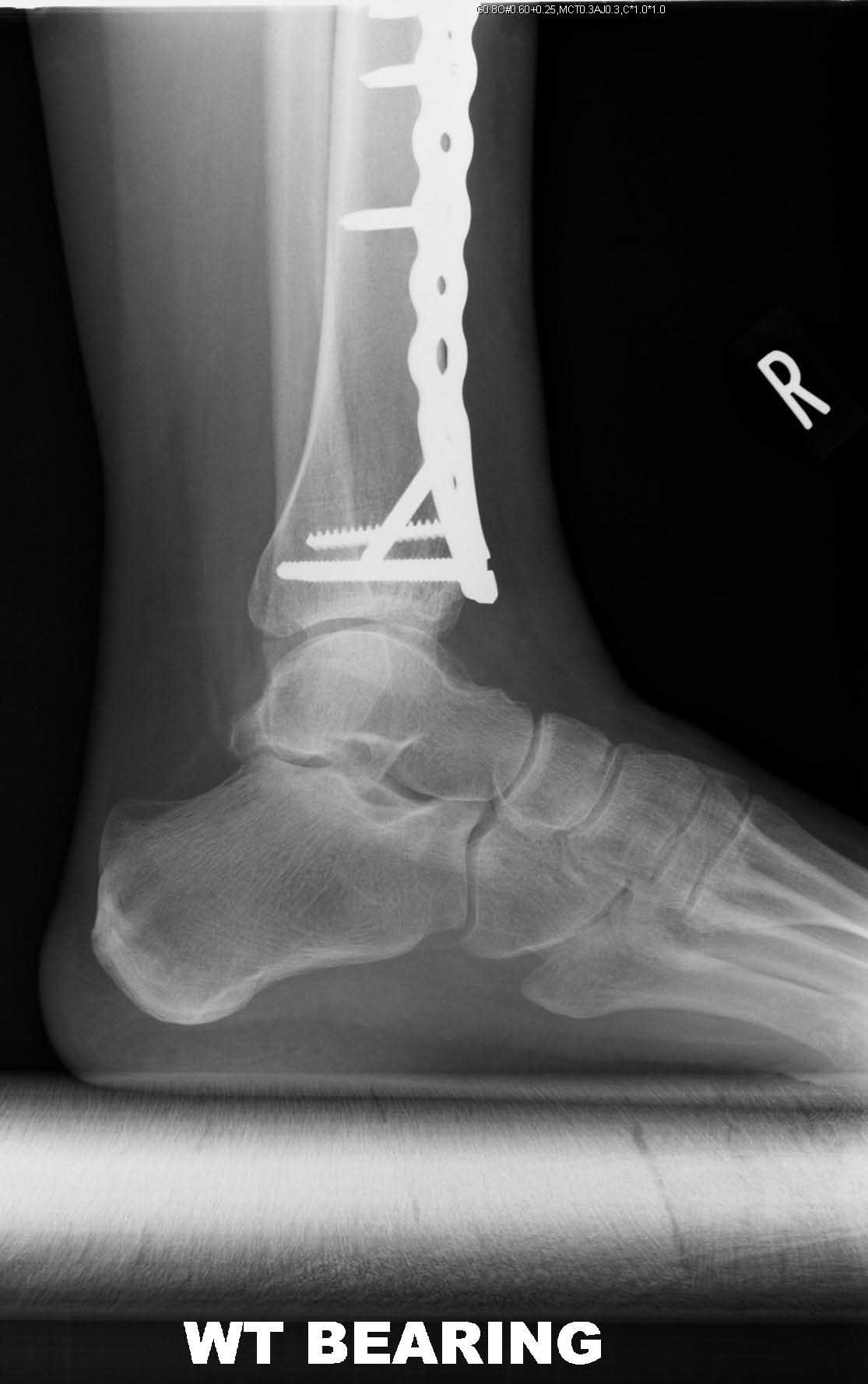 pilon-post-op-lat-sm