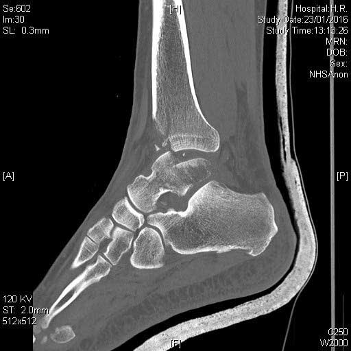 pilon-talus-ct-3