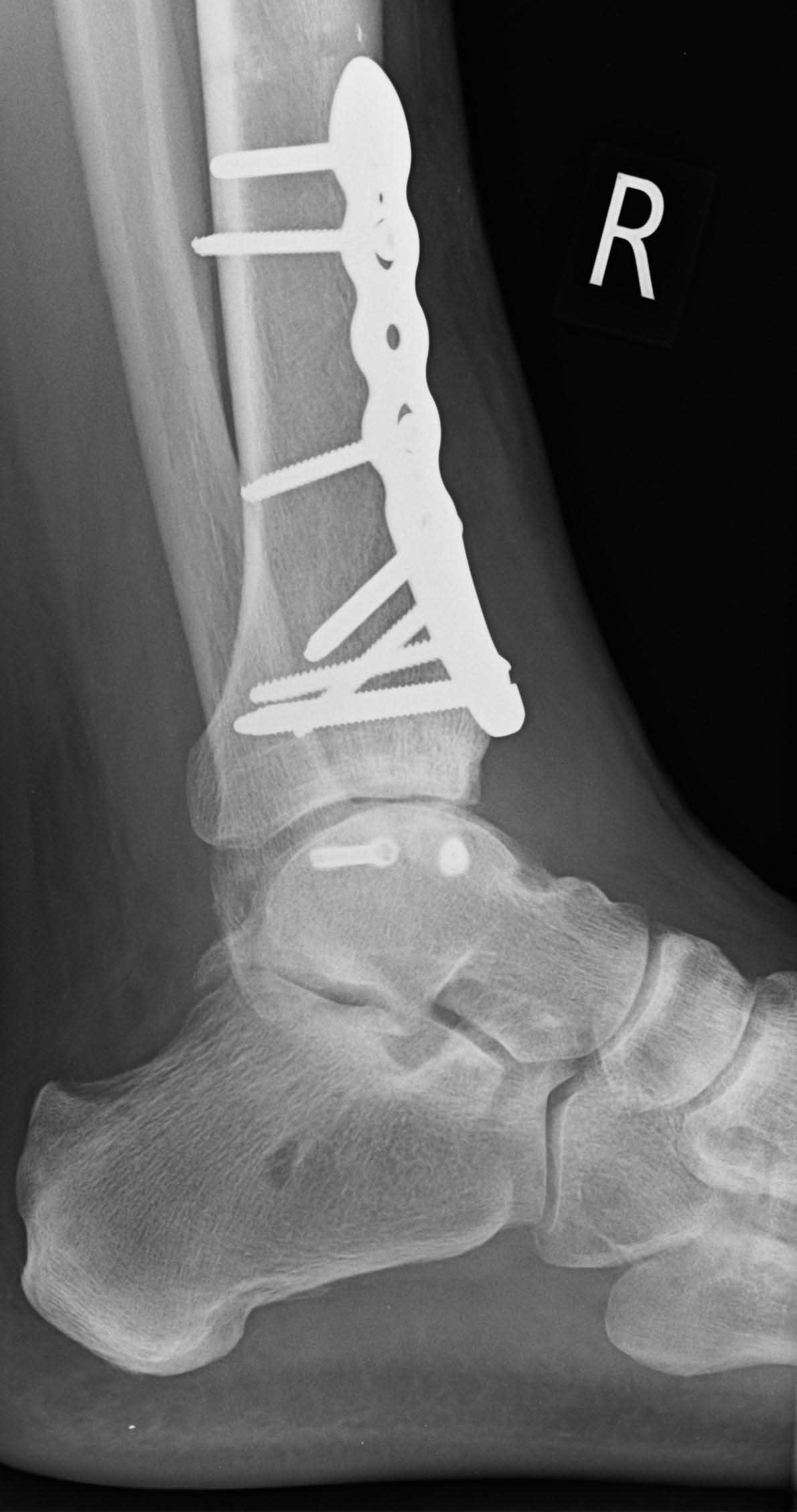 pilon-talus-post-op-lat