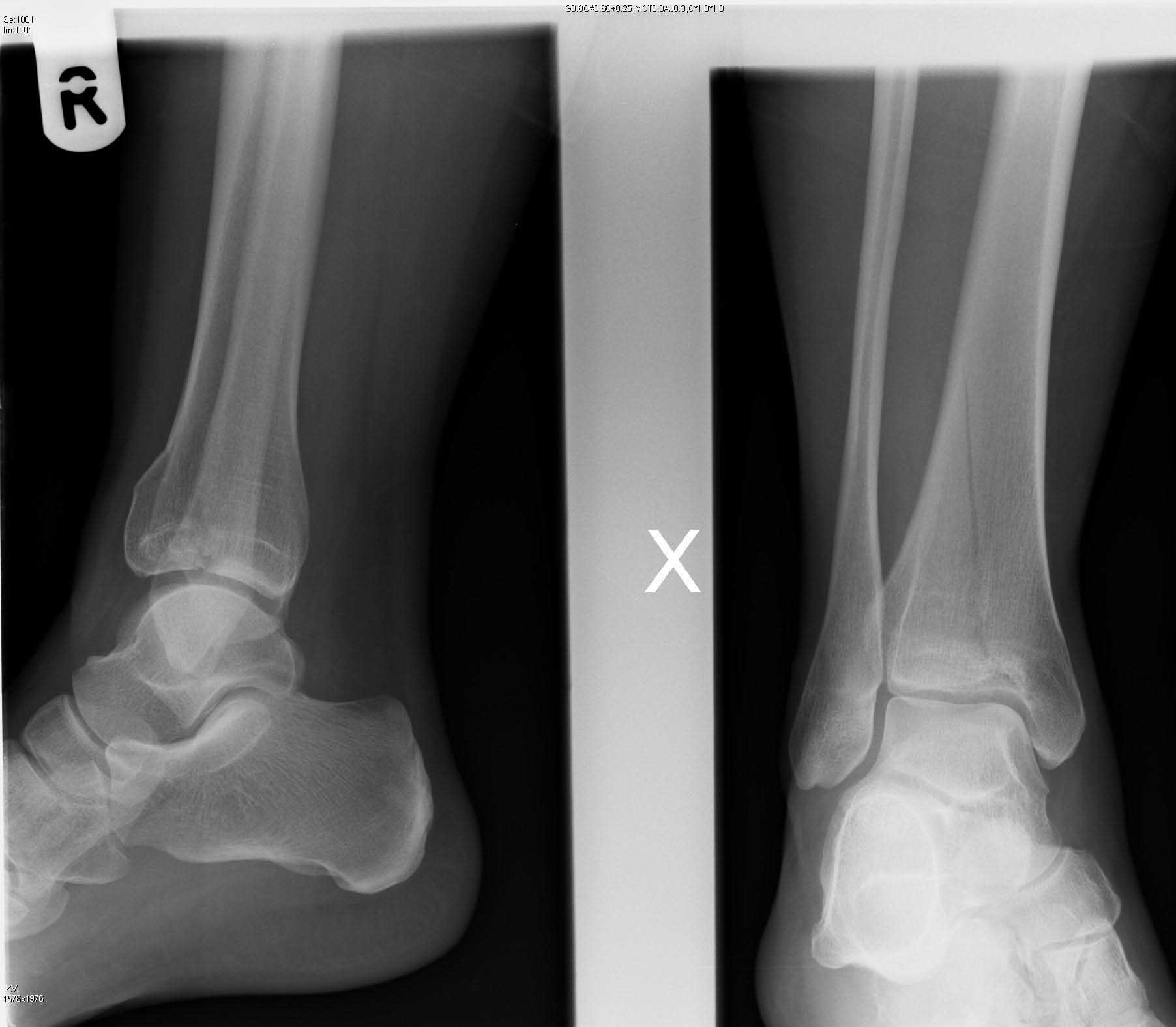 pilon-pre-op-sm