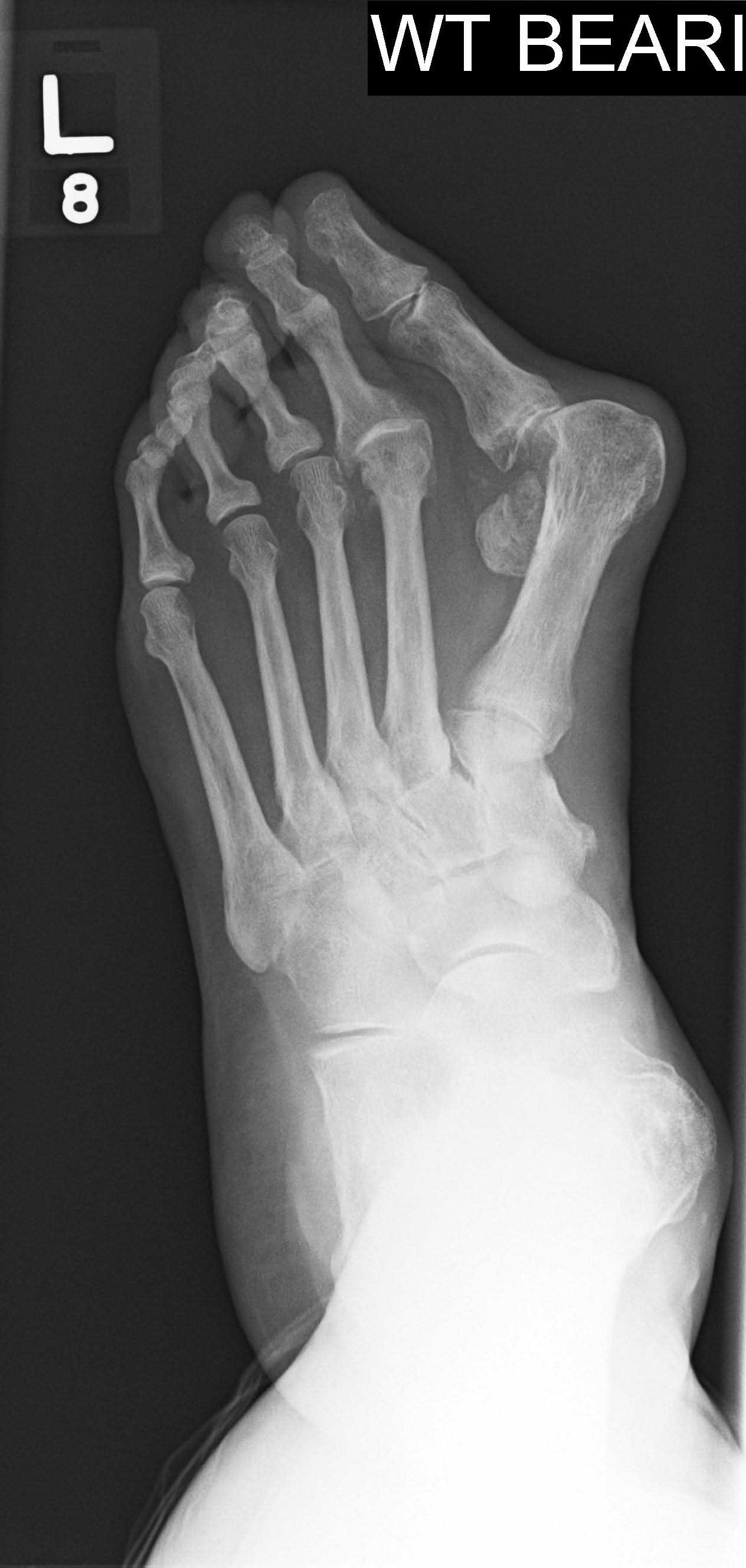 severe-h-valgus-ap-pre-op