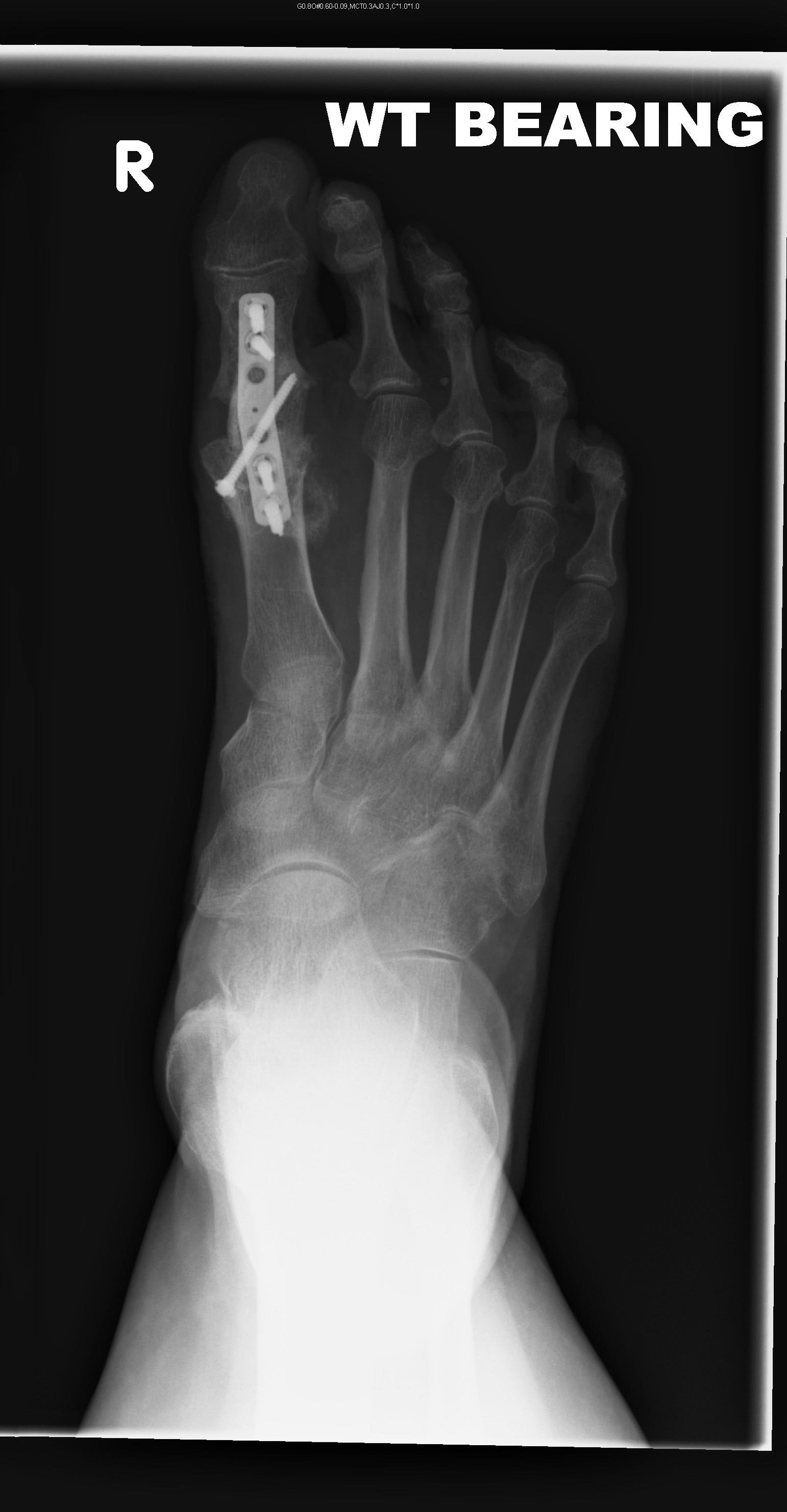 silastic-1stmtpj-post-op